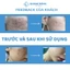 Miếng dán xóa mờ sẹo phẫu thuật ngực Scar FX Breast Anchor của Rejuvaskin