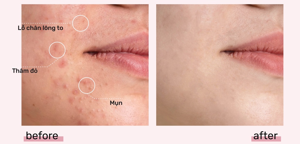 Mô tả Serum Niacinamide 20% Giảm Mụn, Mờ Thâm Đỏ, Thu Nhỏ LCL Derladie Laboratoire Pore Tightening Ampoule 30ml - 2