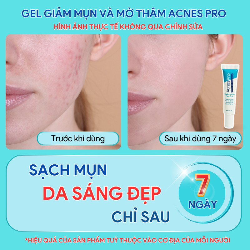 Mô tả Gel giảm mụn AcnesPro Skincare cho da dầu mụn nhạy cảm, giảm mụn viêm, mờ thâm, làm đẹp da sau mụn (20g) - 3