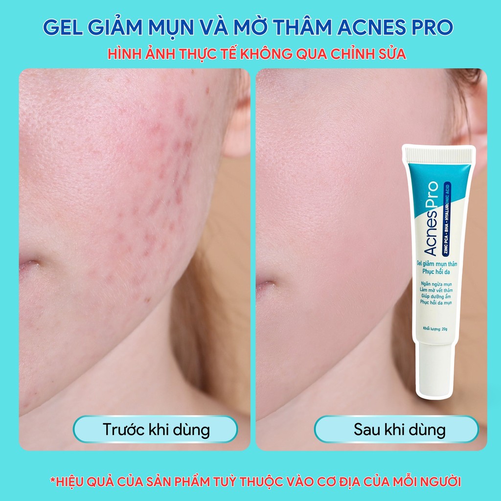 Mô tả Gel giảm mụn AcnesPro Skincare cho da dầu mụn nhạy cảm, giảm mụn viêm, mờ thâm, làm đẹp da sau mụn (20g) - 4