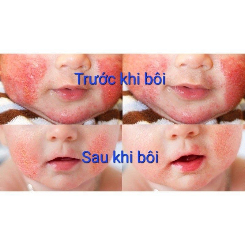 [FREESHIP Toàn Quốc] Kem Bôi Nứt Gót Chân Gia Truyền Thiên Di - Bôi Chàm Cho Bé - Chống Nẻ Hết Nứt Gót Chân Dưỡng Ẩm Da
