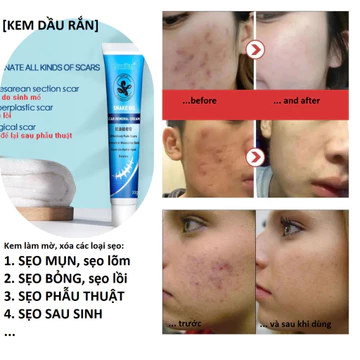 Kem xóa sẹo lồi, sẹo bỏng, sẹo mụn, sẹo sau sinh, thành phần thảo dược, đóng tuýp tiện dụng có thể tự bôi tại nhà