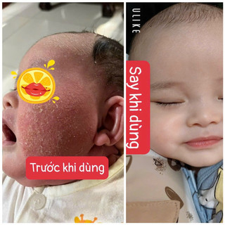 Kem Bôi Nứt Gót Chân Gia Truyền Thiên Di - Kem Bôi Chàm Cho Bé - Kem Chống Nẻ Hết Nứt Gót Chân Dưỡng Ẩm Da