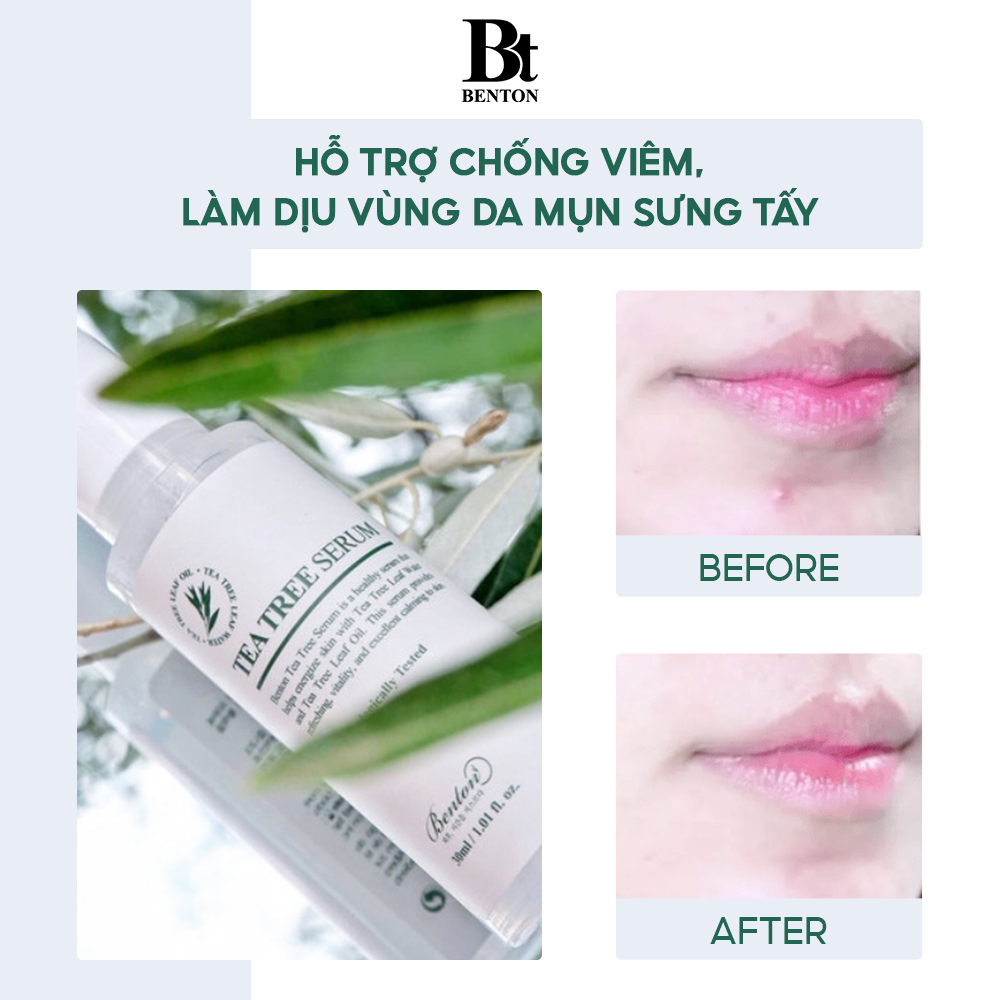 Chọn serum trị mụn cho các làn da dầu hiệu quả nhất