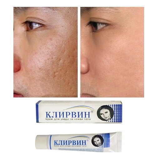 Kem Mờ Sẹo, Mờ Thâm, Rạn Da Klirvin 25g Của Nga