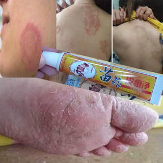 Kem bôi đông y da liễu trung hoa giảm ngứa, chàm, nấm mông hắc lào, vảy nến , á sừng ...