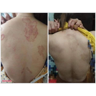 Kem bôi đông y da liễu trung hoa giảm ngứa, chàm, nấm mông hắc lào, vảy nến , á sừng ...