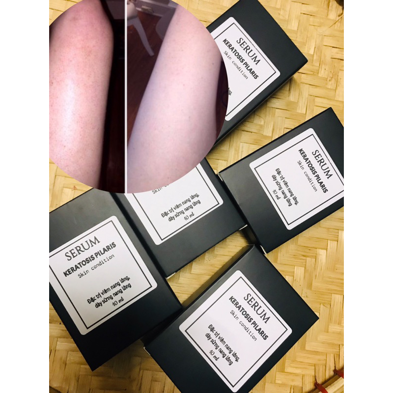 SERUM KERATOSIS PILARIS 10 ML Shopee Việt Nam