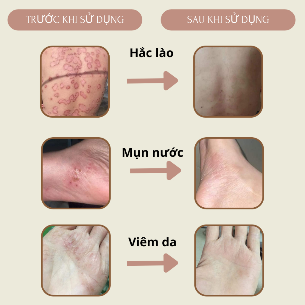 Sáp bôi Lê Gia - Viêm da, hắc lào, nấm ngứa, chàm, nứt nẻ, dịu da... từ thiên nhiên gia truyền