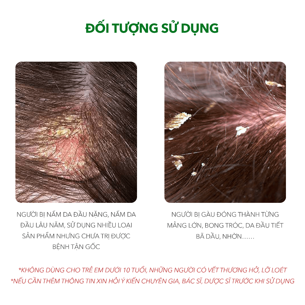 Ảnh Combo Sản Phẩm Ezema 50 & Dầu Gội Sạch Gàu Antisol | Thương Hiệu iCare Pharma | Hỗ Trợ Trị Gàu Ngứa, Nấm Da Đầu Lâu Năm 3