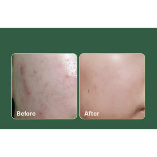 Toner diếp cá giảm mụn ANUA 77 Heartleaf Soothing