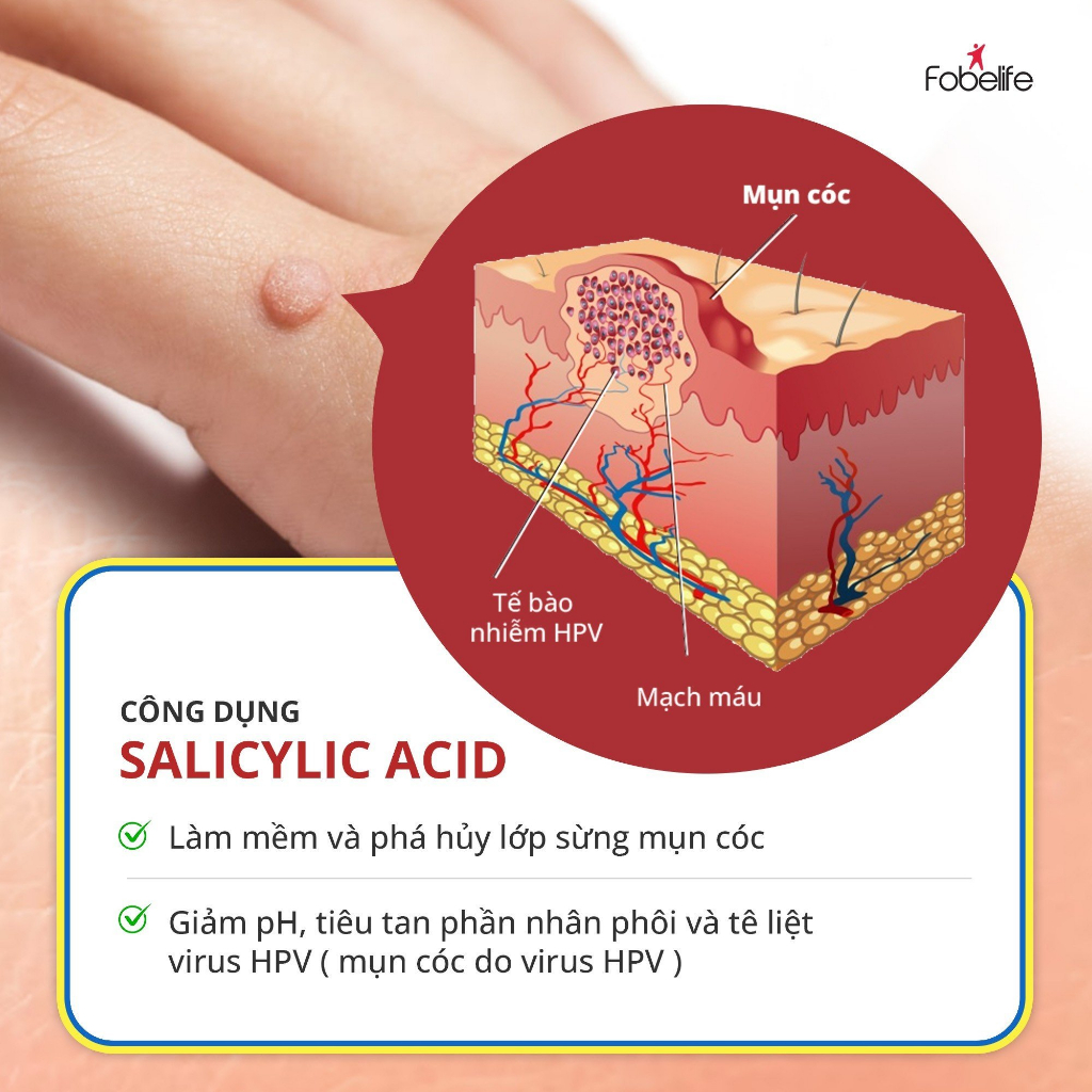 [Combo] 2 hộp miếng dán MỤN CÓC Corn plaster KangDi Fobe hộp 6 miếng N1
