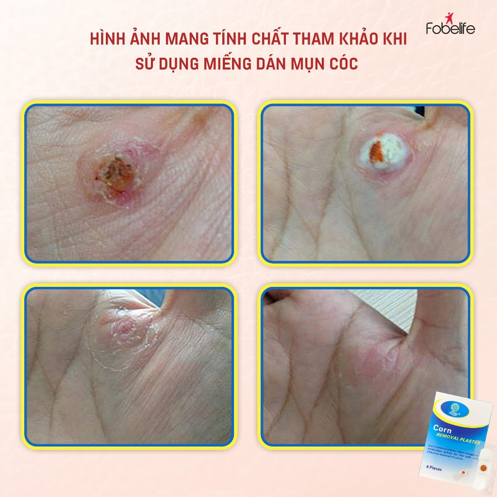[Combo] 2 hộp miếng dán MỤN CÓC Corn plaster KangDi Fobe hộp 6 miếng N1