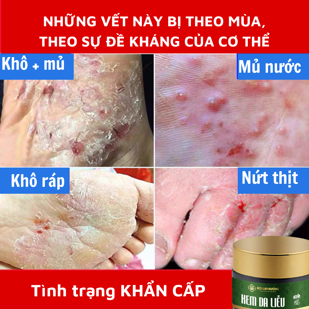 [Ngứa ghẻ lâu năm] Kem bôi da nấm ngứa tổ đỉa hắc lào mề đay zona ghẻ nước kem bôi da muỗi đốt, chữa nhiều nơi