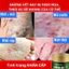 Kem bôi da nấm ngứa tổ đỉa hắc lào mề đay zona ghẻ nước kem bôi da muỗi đốt, chữa nhiều nơi