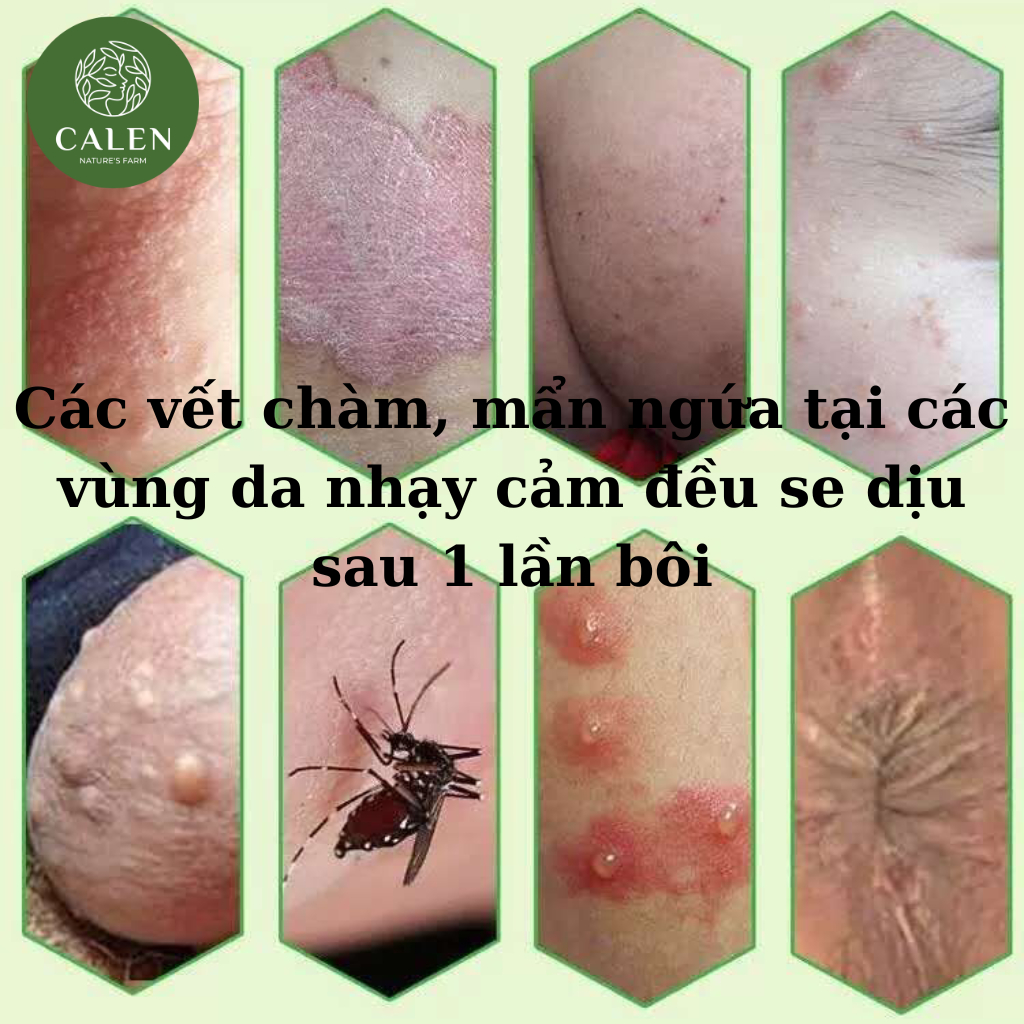 [Ngứa ghẻ lâu năm] Kem bôi da nấm ngứa tổ đỉa hắc lào mề đay zona ghẻ nước kem bôi da muỗi đốt, chữa nhiều nơi
