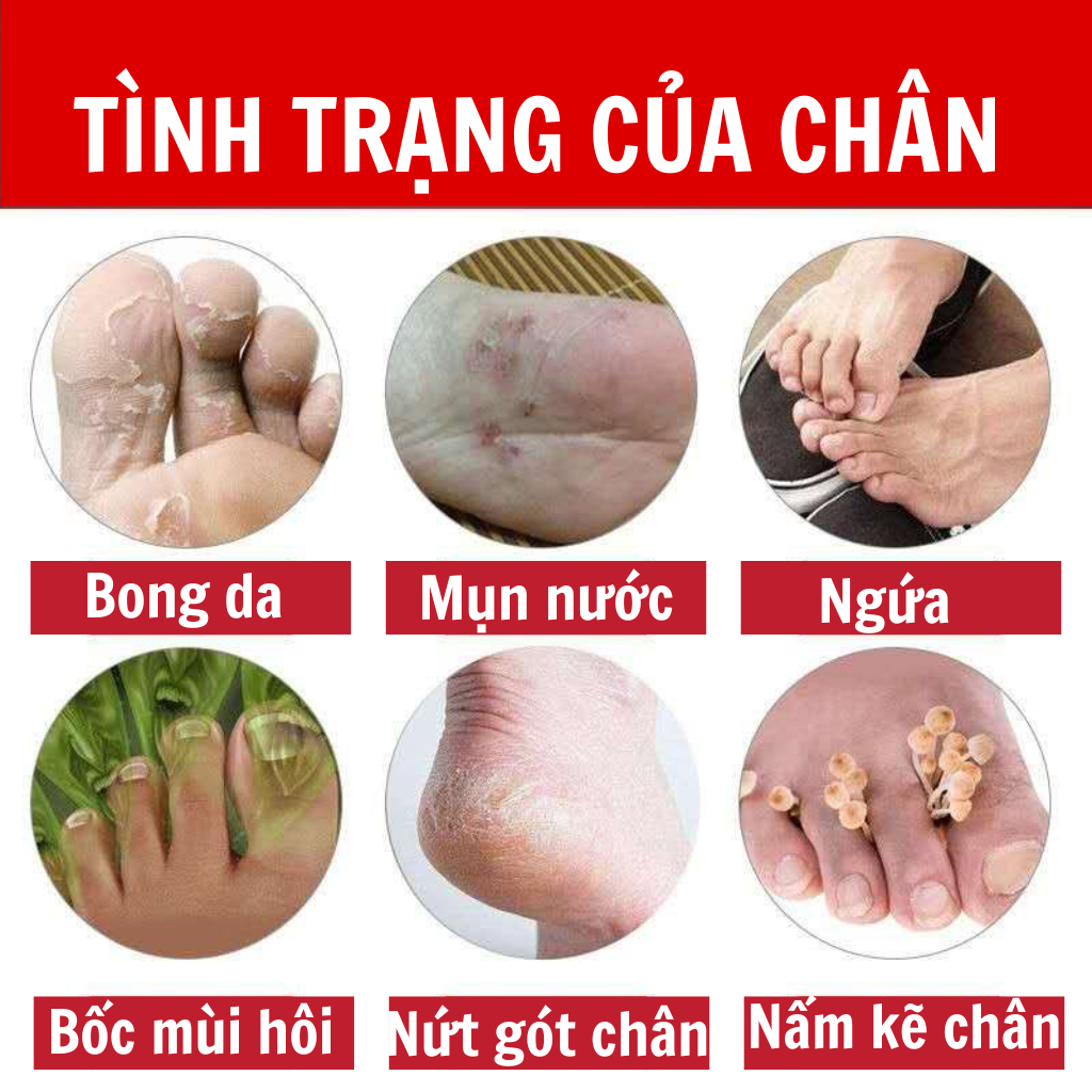 [Ngứa ghẻ lâu năm] Kem bôi da nấm ngứa tổ đỉa hắc lào mề đay zona ghẻ nước kem bôi da muỗi đốt, chữa nhiều nơi