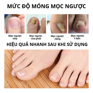 Serum phục hồI móng chân bị mọc ngược làm sáng sạch khử mùI khử khuẩn