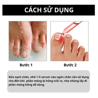 Serum phục hồI móng chân bị mọc ngược làm sáng sạch khử mùI khử khuẩn