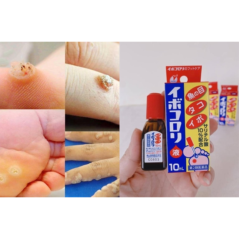 DUNG DỊCH CHẤM MỤC CÓC NỘI ĐỊA NHẬT BẢN IBOKORORI 10ML | Shopee Việt Nam