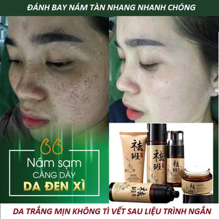Bộ kem dưỡng da giảm nám bộ kem nám chống tàn nhang thảo dược trắng sáng dưỡng ẩm