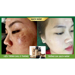 Bộ kem dưỡng da giảm nám bộ kem nám chống tàn nhang thảo dược trắng sáng dưỡng ẩm
