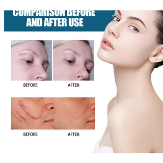 Serum sẹo lồi,sẹo lõm, rỗ lâu năm Treatment V3