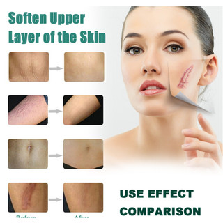 Serum sẹo lồi,sẹo lõm, rỗ lâu năm Treatment V3