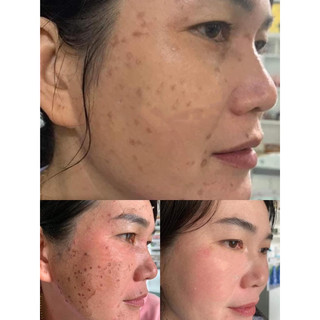 Tẩy Nốt Ruồi Tại Nhà Xoá Mụn Ruồi Tàn Nhang Mụn Thịt Dư lọ 8g