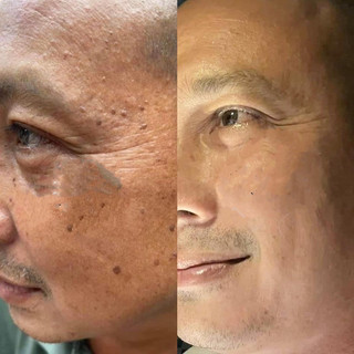 Tẩy Nốt Ruồi Tại Nhà Xoá Mụn Ruồi Tàn Nhang Mụn Thịt Dư lọ 8g