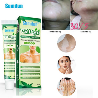 Kem bôi hắc lào lang ben nấm ngứa bện ngoài da Sumifun chiết xuất thảo dược 100% tuýp 20g