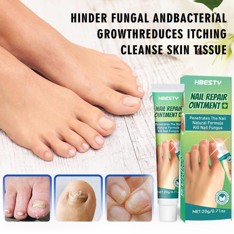 kem phục hồi móng,kích thích mọc móng và chống nấm 20ml