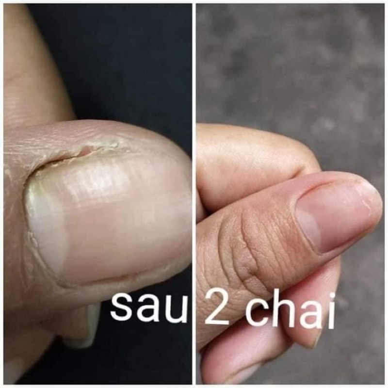 [Combo 5 lọ] Serum nấm móng tay chân , bọng móng, hư khoé, nước ăn tay chân, dưỡng cứng móng gia truyền 4ml
