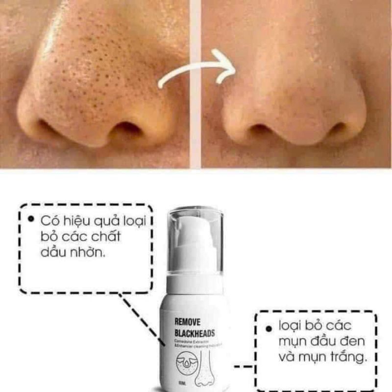 Ủ mụn đầu đen, mụn cám Remove Blackheads chai 50ml