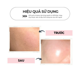 Mặt nạ lột mụn đầu đen Topcharm thu nhỏ lỗ chân lông, dưỡng da trắng hồng
