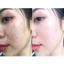𝗦𝗲𝘁 𝗸𝗲𝗺 nám 𝗬𝗮𝗛𝗲𝗲 chính hãng thái lan