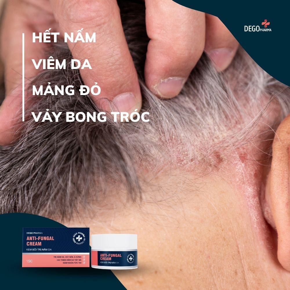 Ảnh Kem bôi nấm da hắc lào mề đay vảy nến á sừng eczema Dego Pharma 30g 2