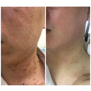 Combo 2 Cao Xoá Sẹo Collagen Mờ Sẹo Lồi Lõm Giúp Nhanh Lành Vết Thương Không Để Lại Sẹo