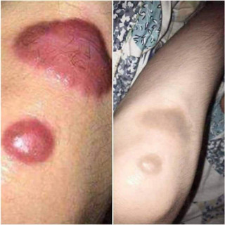 Combo 2 Cao Xoá Sẹo Collagen Mờ Sẹo Lồi Lõm Giúp Nhanh Lành Vết Thương Không Để Lại Sẹo
