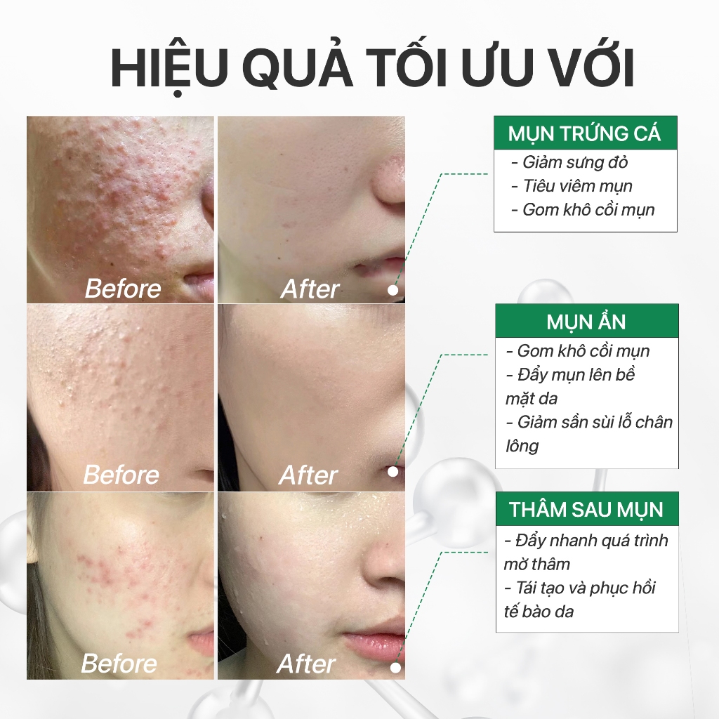 Ảnh Serum sạch mụn giảm thâm chuyên cho bà bầu da mụn, gom khô mụn với tràm trà GUO 10ml, 30ml 4