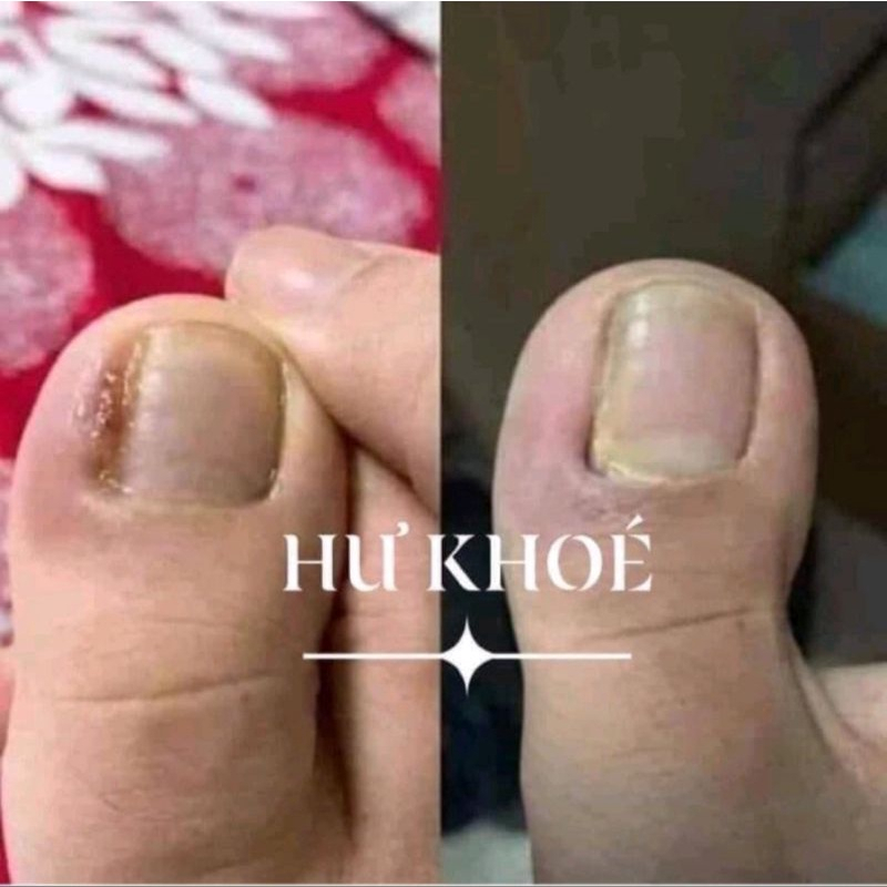 (Combo 10 lọ)Serum nấm móng tay chân, bọng móng, hư khoé, nước ăn tay chân, dưỡng cứng móng gia truyền 4ml