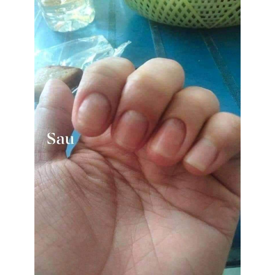 (Combo 10 lọ)Serum nấm móng tay chân, bọng móng, hư khoé, nước ăn tay chân, dưỡng cứng móng gia truyền 4ml