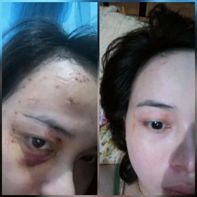 (Combo 2 hũ) Cao Xoá Sẹo Collagen Mờ Sẹo Lồi Lõm Giúp Nhanh Lành Vết Thương Không Để Lại Sẹo