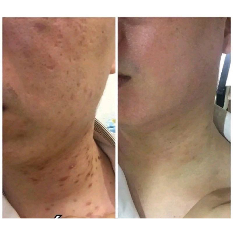 (Combo 2 hũ) Cao Xoá Sẹo Collagen Mờ Sẹo Lồi Lõm Giúp Nhanh Lành Vết Thương Không Để Lại Sẹo