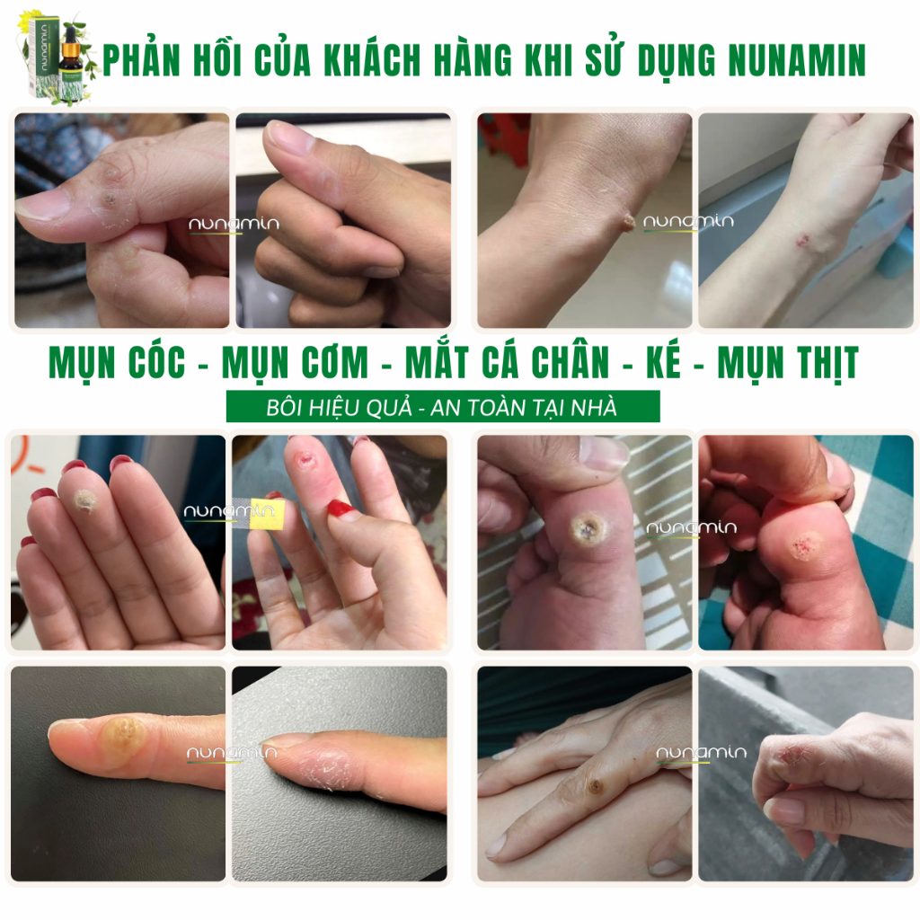 Tinh Chất Chấm Rụng Mụn Cóc, Mụn Cơm, Mụn Thịt, Mắt Cá Chân Lâu Năm [Nanumin 15ML]