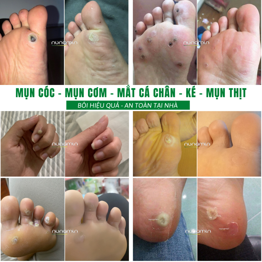 Tinh Chất Chấm Rụng Mụn Cóc, Mụn Cơm, Mụn Thịt, Mắt Cá Chân Lâu Năm [Nanumin 15ML]