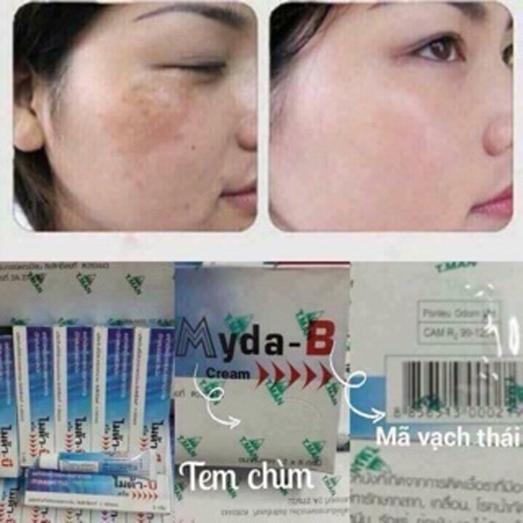 Kem dưỡng da nám , tàn nhang Myda-B 15g - 25g chính hãng