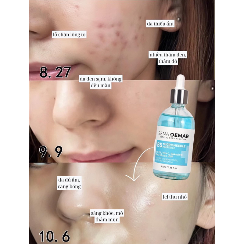 Serum B5 sena demar b5 microneedle ampoule giúp dưỡng ẩm, giảm nhăn, 50ml/100ml - hạn 2028 serum b5 senademar  IS419