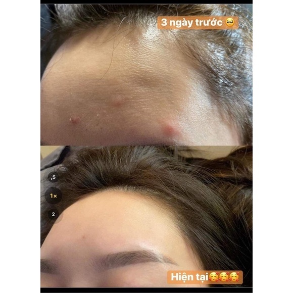 Serum giảm mụn thâm rỗ - Skin 7 Days - Công dụng 5 trong 1 hiệu quả sau 7 ngày