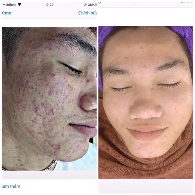 Serum giảm mụn thâm rỗ - Skin 7 Days - Công dụng 5 trong 1 hiệu quả sau 7 ngày